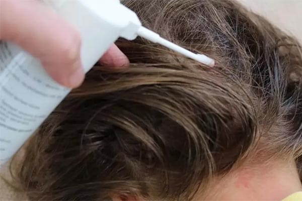 Педикульоз: позбавляємося за допомогою народної медицини 1